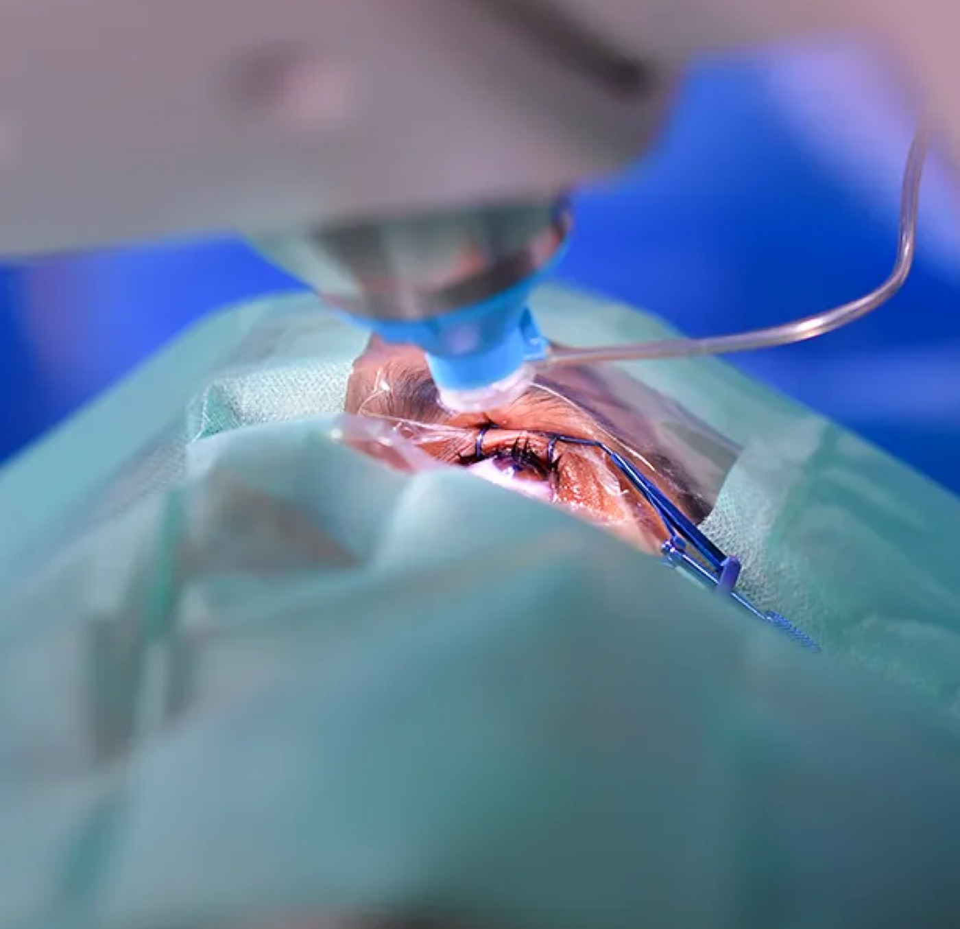 Femtosecond laser used for laser-assisted cataract and refractive surgery